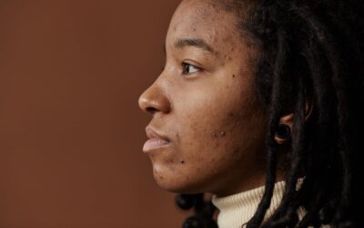 How Hawaii’s Humidity Affects Acne and the Best Treatments for Island Skin