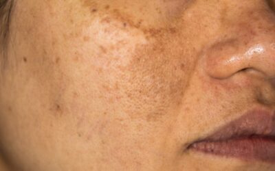 Understanding Hyperpigmentation in Hawai‘i: Causes, Prevention, and Treatment